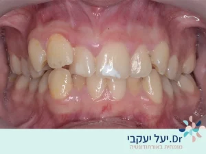צפיפות חמורה בשיניים