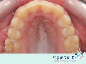צפיפות בשיניים אחרי טיפול 