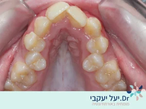 צפיפות בשיניים לפני טיפול