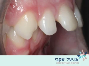 לסת עליונה בולטת ודרכי הטיפול בה | ד